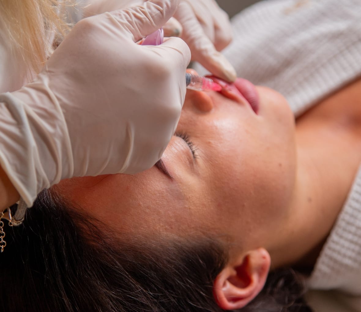 derma filler treatment