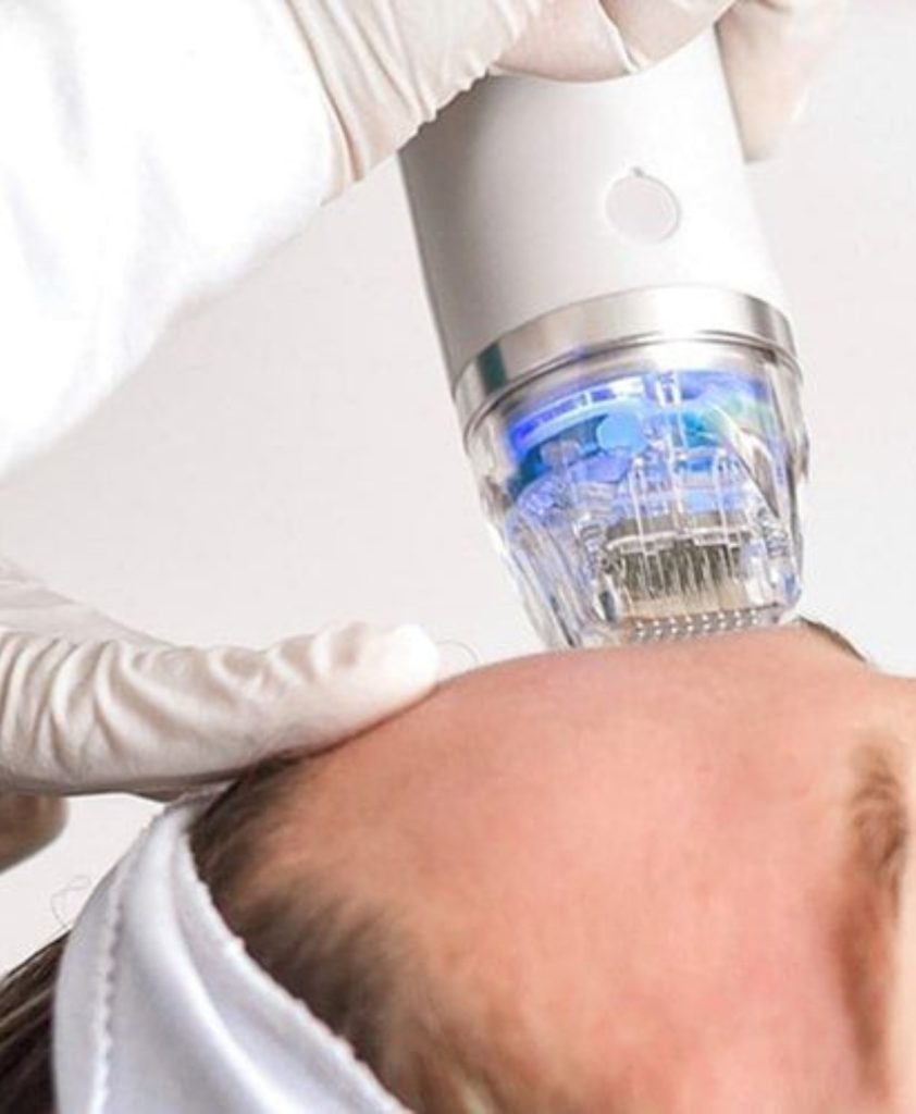 rf microneedling treatment
