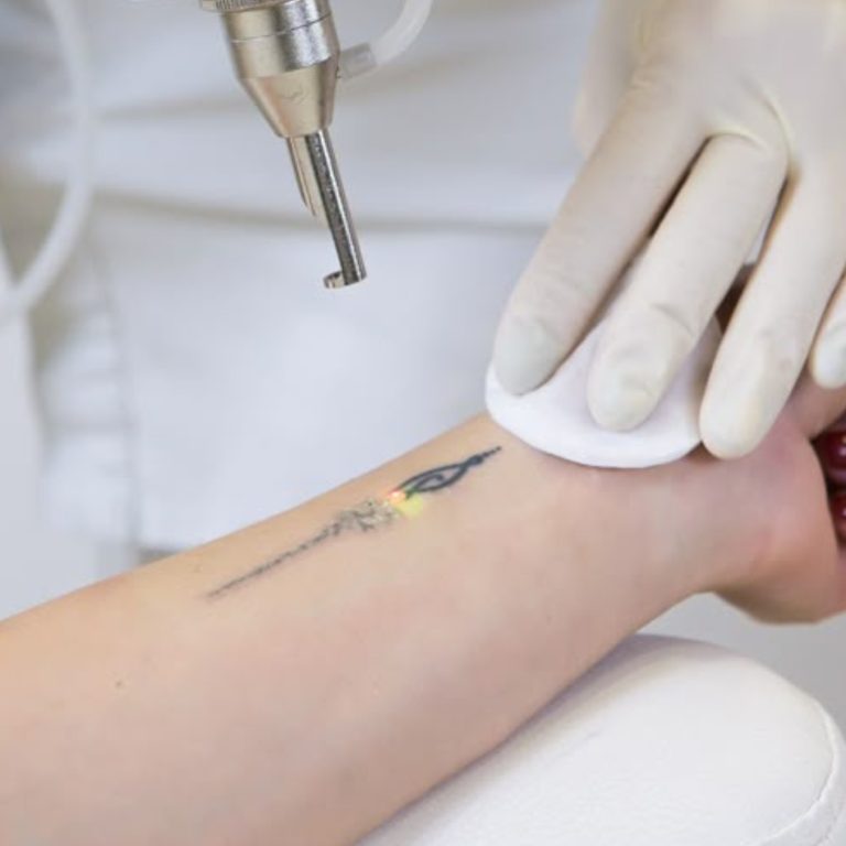 someone getting their tattoo remove